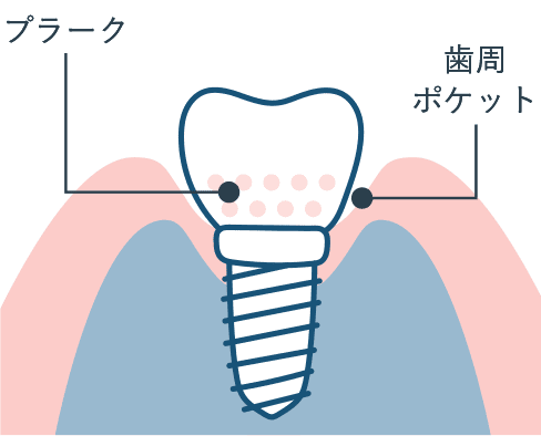 インプラント周囲粘膜炎
